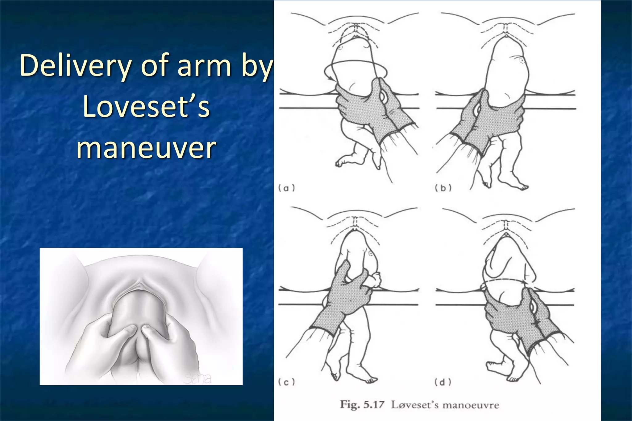 Breech Obstetrics. | PDF