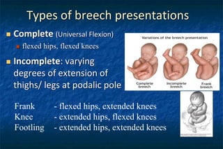 breech presentation hips