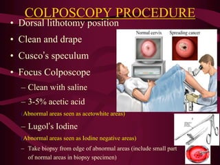 COLPOSCOPY PROCEDURE
• Dorsal lithotomy position
• Clean and drape
• Cusco’s speculum
• Focus Colposcope
– Clean with saline
– 3-5% acetic acid
(Abnormal areas seen as acetowhite areas)
– Lugol’s Iodine
(Abnormal areas seen as Iodine negative areas)
– Take biopsy from edge of abnormal areas (include small part
of normal areas in biopsy specimen)
Biopsy
Area
 