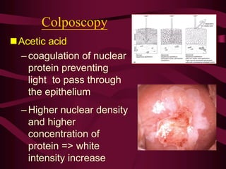 Colposcopy
nAcetic acid
–coagulation of nuclear
protein preventing
light to pass through
the epithelium
–Higher nuclear density
and higher
concentration of
protein => white
intensity increase
 