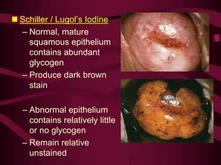 n Schiller / Lugol’s Iodine
– Normal, mature
squamous epithelium
contains abundant
glycogen
– Produce dark brown
stain
– Abnormal epithelium
contains relatively little
or no glycogen
– Remain relative
unstained
 