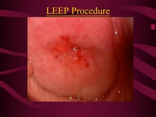 LEEP Procedure
 