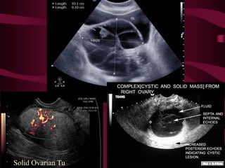 Solid Ovarian Tu
 