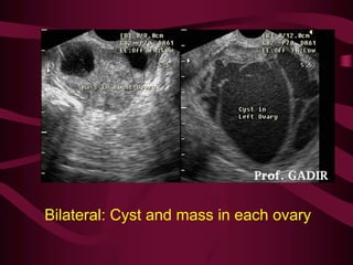 Bilateral: Cyst and mass in each ovary
 