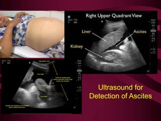 Ultrasound for
Detection of Ascites
 