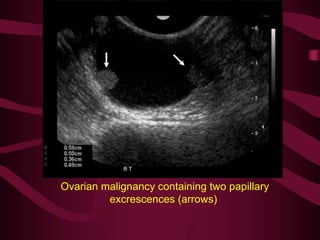 Ovarian malignancy containing two papillary
excrescences (arrows)
 
