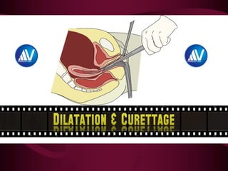 Dilatation & Curettage
 