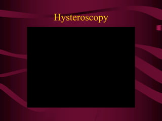 Hysteroscopy
 