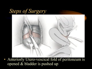 Steps of Surgery
• Anteriorly Utero-vescical fold of peritoneum is
opened & bladder is pushed up
 