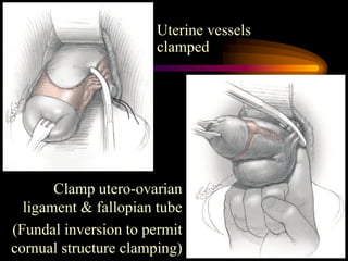 Uterine vessels
clamped
Clamp utero-ovarian
ligament & fallopian tube
(Fundal inversion to permit
cornual structure clamping)
 