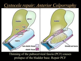 Cystocele repair: Anterior Colporraphy
Thinning of the pubocervical fascia (PCF) causes
prolapse of the bladder base. Repair PCF
 