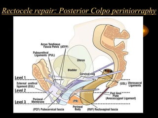 Rectocele repair: Posterior Colpo periniorraphy
 