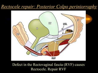 Rectocele repair: Posterior Colpo periniorraphy
Defect in the Rectovaginal fascia (RVF) causes
Rectocele. Repair RVF
 