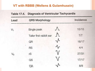 VT with RBBB (Wellens & Gulamhusein)
 