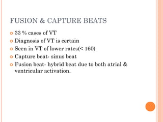 FUSION & CAPTURE BEATS
 33 % cases of VT
 Diagnosis of VT is certain
 Seen in VT of lower rates(< 160)
 Capture beat- sinus beat
 Fusion beat- hybrid beat due to both atrial &
ventricular activation.
 