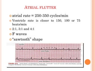 ATRIAL FLUTTER
 atrial rate = 250-350 cycles/min
 Ventricle rate is closer to 150, 100 or 75
beats/min
 2:1, 3:1 and 4:1
 F waves
 “sawtooth” shape
 