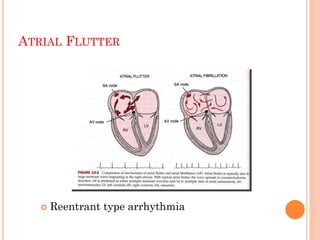 ATRIAL FLUTTER
 Reentrant type arrhythmia
 