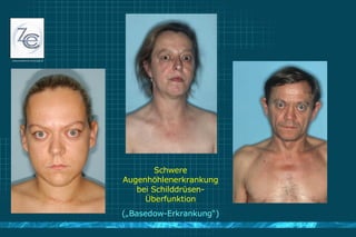 Schwere Augenhöhlenerkrankung bei Schilddrüsen-Überfunktion („Basedow-Erkrankung“)‏ 