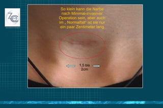 1,5 bis 2cm So klein kann die Narbe nach Minimal-invasiver Operation sein, aber auch im „ Normalfall“ ist sie nur ein paar Zentimeter lang 