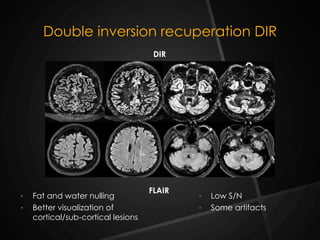 Double inversion recuperation DIR
•  Fat and water nulling
•  Better visualization of
cortical/sub-cortical lesions
•  Low S/N
•  Some artifacts
DIR
FLAIR
 