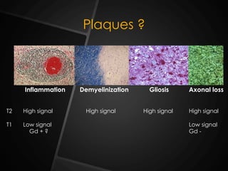 Plaques ?
Inflammation Demyelinization Gliosis Axonal loss
T2 High signal High signal High signal High signal
T1 Low signal Low signal
Gd + ? Gd -
 