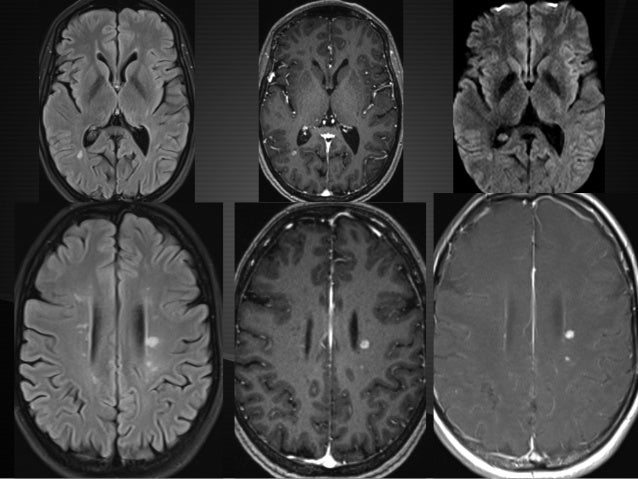r lavayssiere mri and multiple sclerosis in clinical practice jfim h