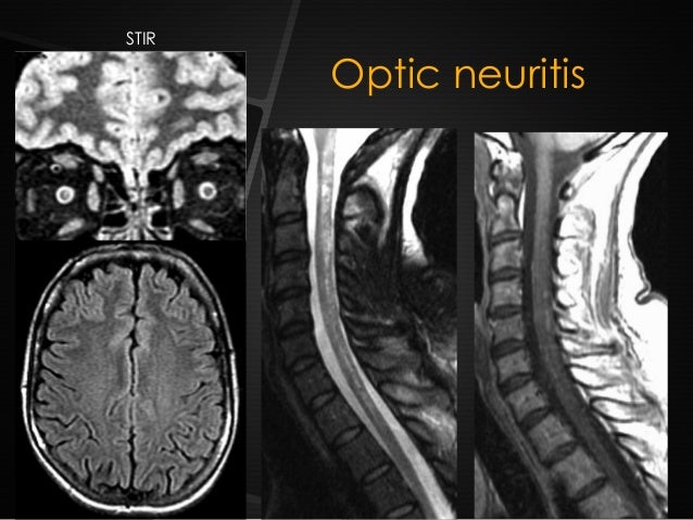 r lavayssiere mri and multiple sclerosis in clinical practice jfim h