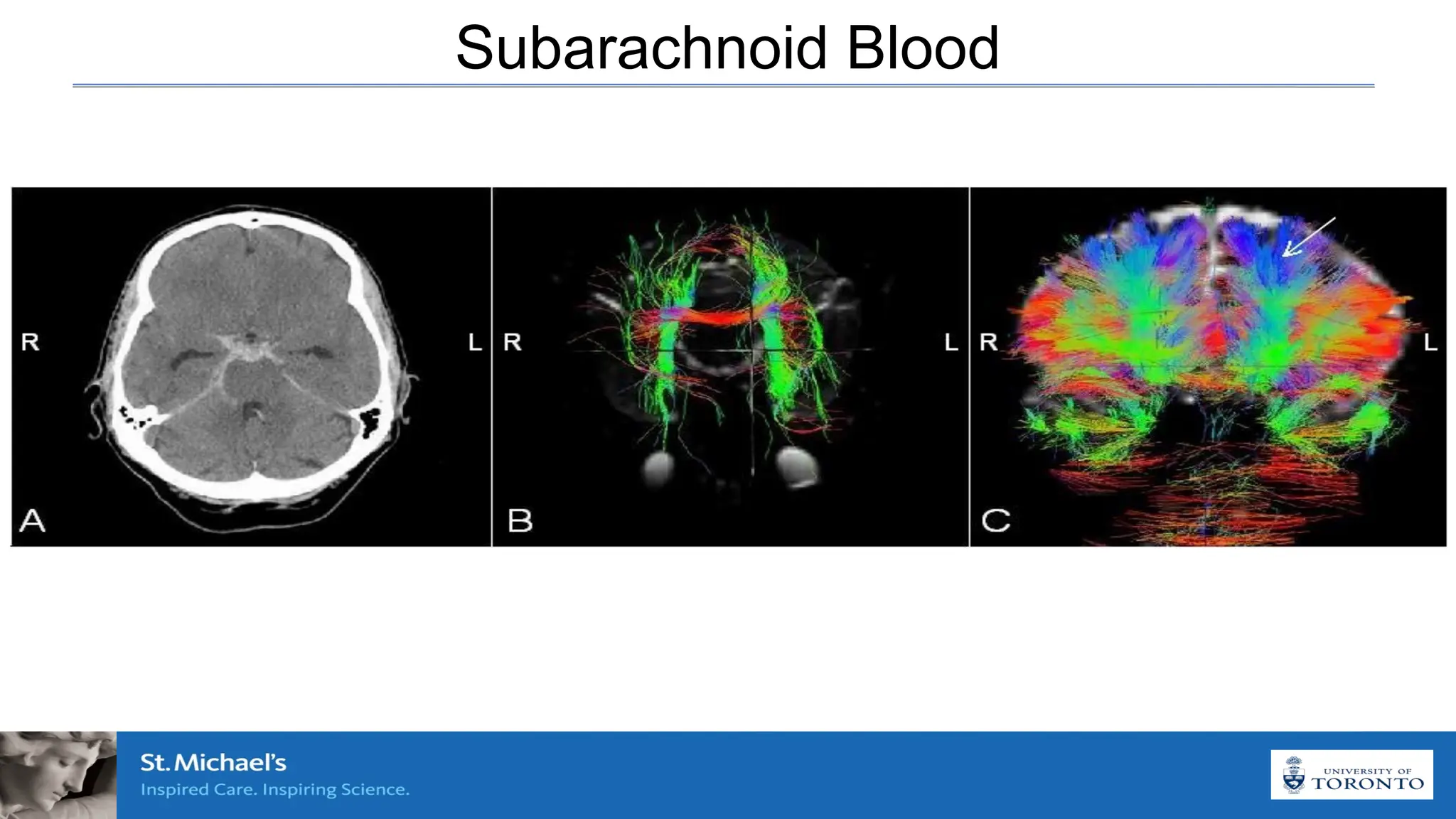 Subarachnoid Blood
 