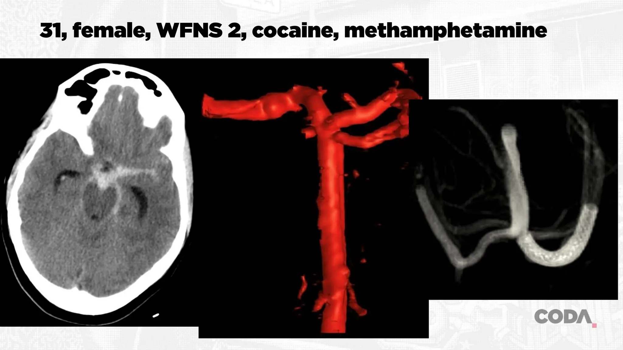 31, female, WFNS 2, cocaine, methamphetamine
 