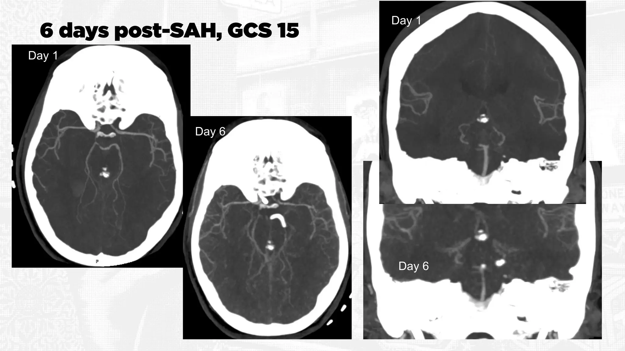 6 days post-SAH, GCS 15
Day 1
Day 6
Day 6
Day 1
 