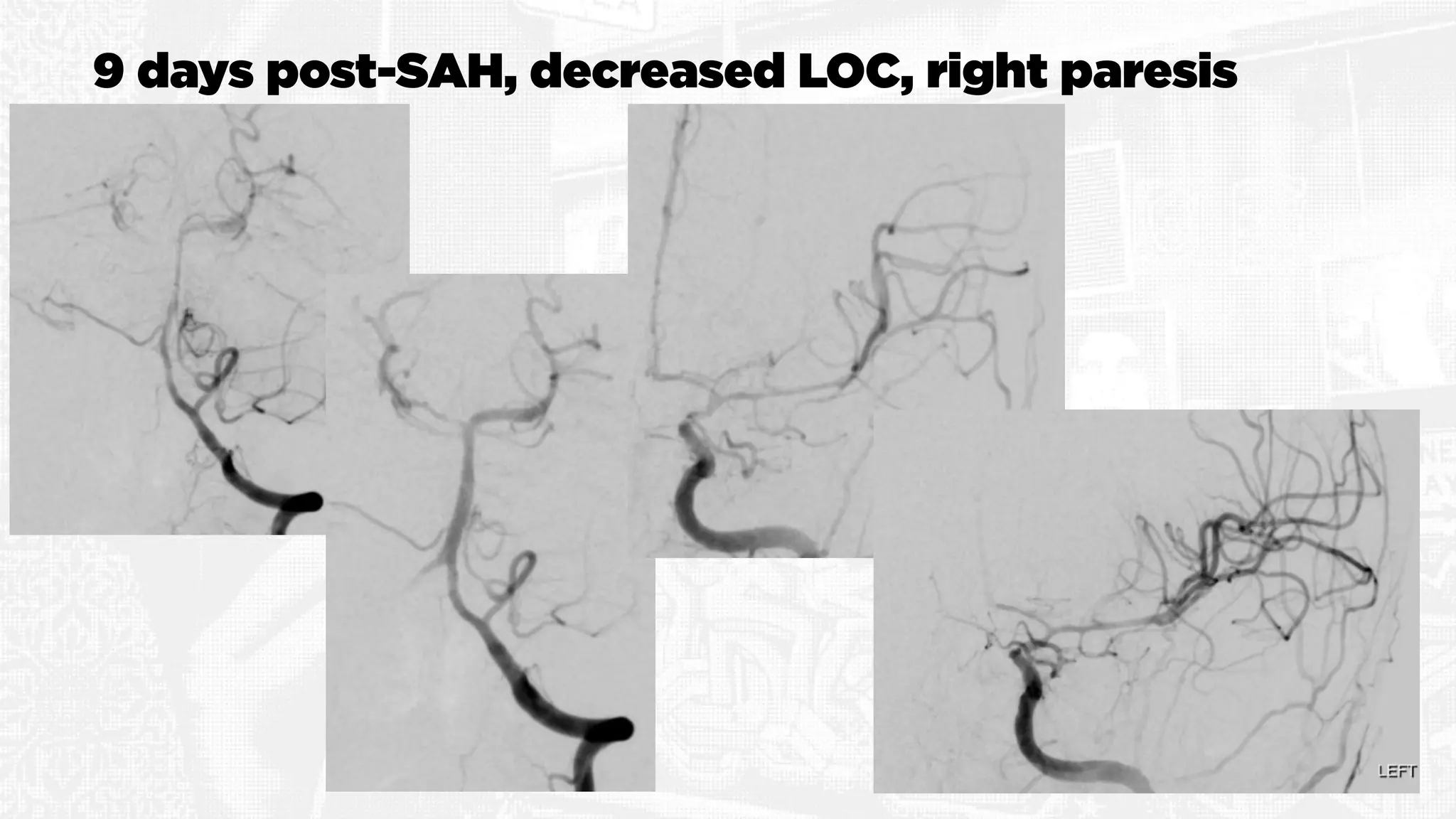9 days post-SAH, decreased LOC, right paresis
 