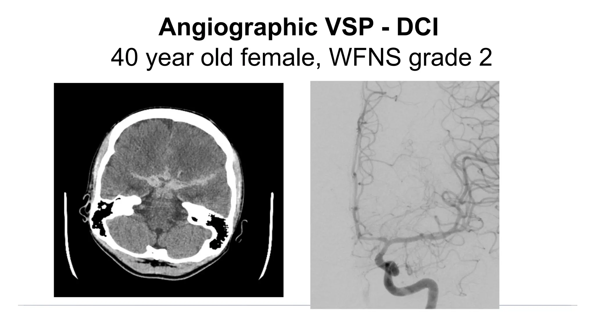 Angiographic VSP - DCI
40 year old female, WFNS grade 2
 