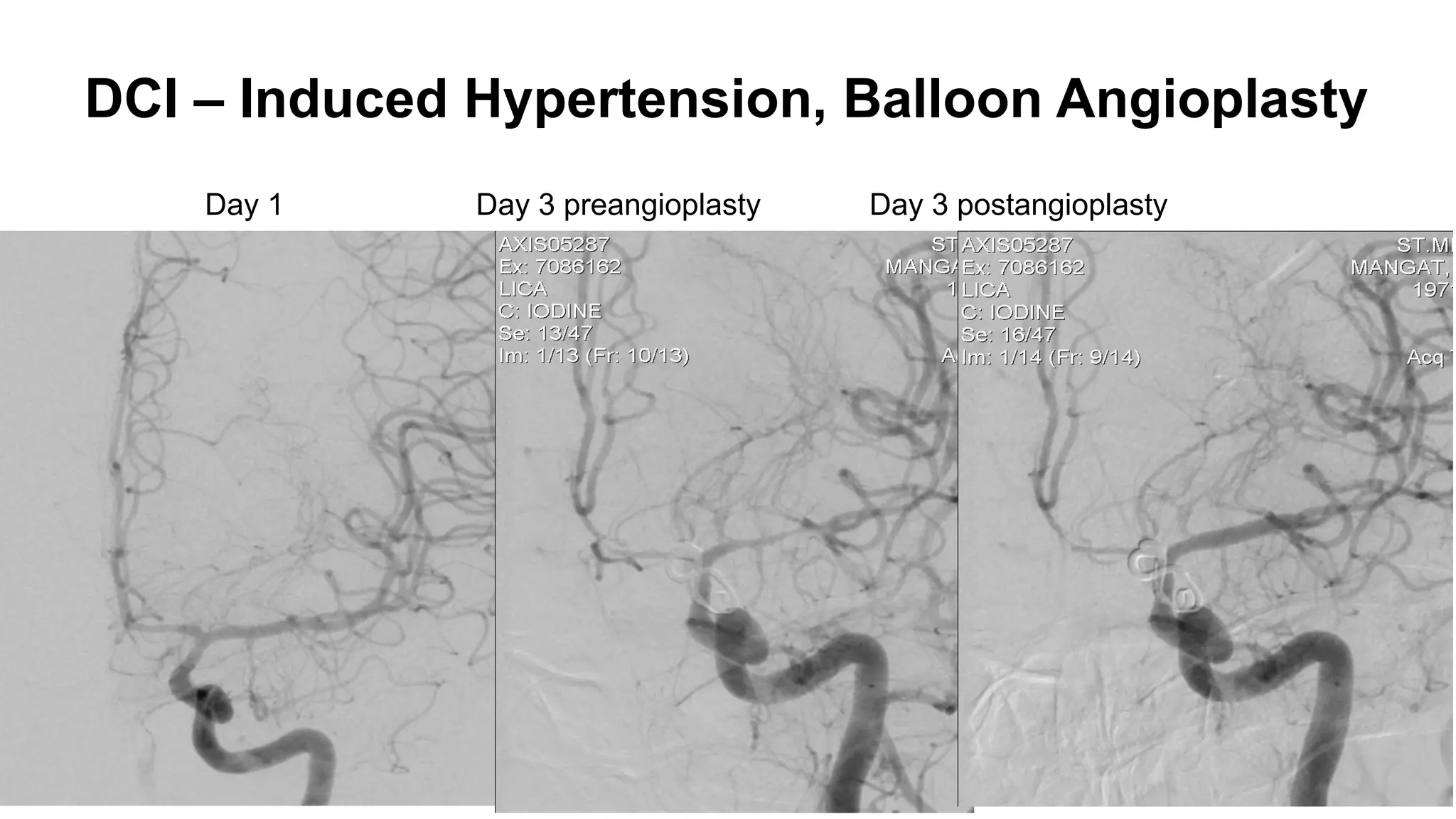 DCI – Induced Hypertension, Balloon Angioplasty
Day 1 Day 3 preangioplasty Day 3 postangioplasty
 