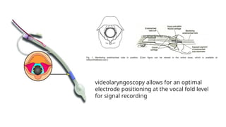 RLN INJURy in surgery of surgical principles of thyroidectomy | PPTX