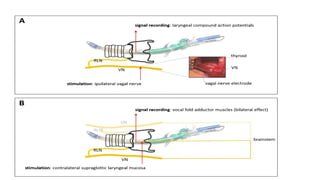 RLN INJURy in surgery of surgical principles of thyroidectomy | PPTX