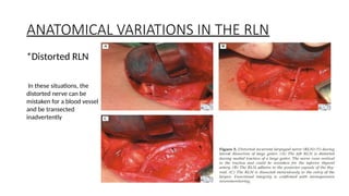 Left Rln Path RLN INJURy in surgery of surgical principles of thyroidectomy | PPTX