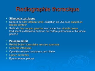 Radiographie thoracique Silhouette cardiaque Débord de  l’arc inférieur droit  ,dilatation de OG avec  aspect en   double contour Saillit de  l’arc moyen gauche  avec aspect en  double bosse  traduisant la dilatation du tronc de l’artére pulmonaire et l’auricule gauche Poumon mitral Redistribution vasculaire vers les sommets Oedème interstitiel Opacités réticulo nodulaires peri hilaire Lignes de Kerley Epenchement pleural  