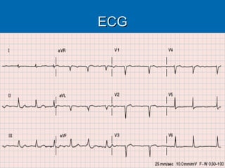 ECG 