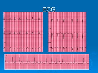 ECG 