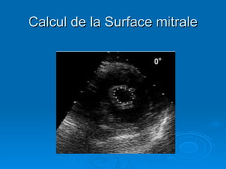 Calcul de la Surface mitrale 