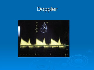 Doppler 