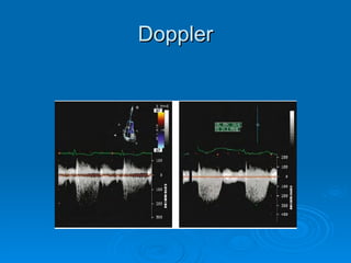 Doppler 