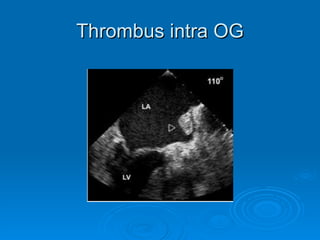 Thrombus intra OG 