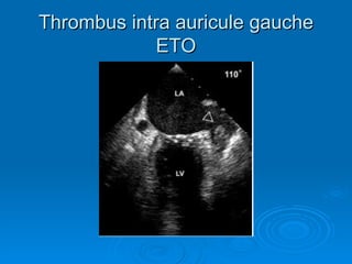 Thrombus intra auricule gauche ETO 