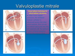 Valvuloplastie mitrale Inoue balloon technique for mitral balloon valvotomy . A.  After trans-septal puncture, the deflated balloon catheter is advanced across the inter-atrial septum, then across the mitral valve and into the left ventricle.   B.  The balloon is then inflated stepwise within the mitral orifice.  