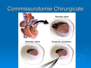 Commissurotomie Chirurgicale 