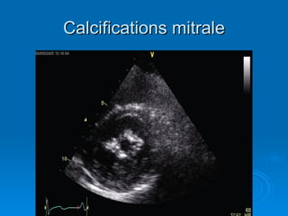 Calcifications mitrale 