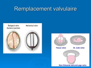 Remplacement valvulaire 