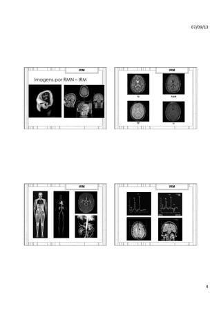 07/09/13	
  
4	
  
Imagens por RMN – IRM
IRM
T2 FLAIR
T2* T1
IRM
IRM IRM
 