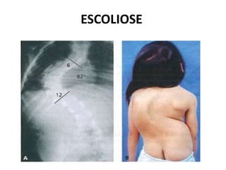 ESCOLIOSE
 